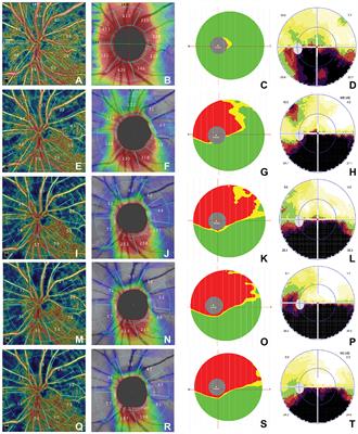 Detecting changes in the blood flow of the optic disk in patients with nonarteritic anterior ischemic optic neuropathy via optical coherence tomography–angiography